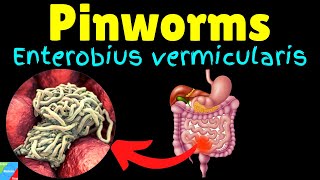 Pinworms Threadworms Symptoms Causes Treatments Life Cycle – Enterobius vermicularis [upl. by Doak]