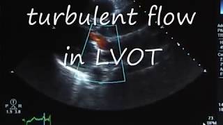 Systolic Anterior MotionSAM following Mitral Valve Prolapse Repair [upl. by Gomer]