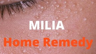 Milia treatment [upl. by Eittel421]