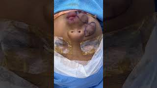 Hemangioma for a kid  best resection and Reconstructive surgery [upl. by Tull884]