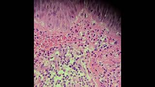 Vasculite leucocitoclástica vasculitis dermatopathology skinbiopsy legulcers [upl. by Almita]