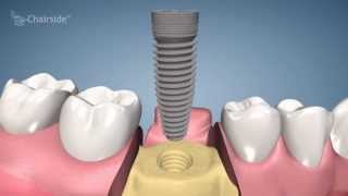 Dental Implant Procedure  One Stage [upl. by Docia698]