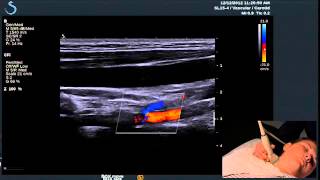 Hot Tips  Finding the Vertebral Artery with Ultrasound [upl. by Haleemak]