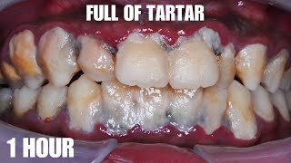 SCALING  SATISFYING  TARTAR  Dentist  Dokter Gigi Tri Putra [upl. by Asennav]