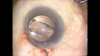 enVista intraocular lens by Bausch amp Lomb Insertion VideoOctober 29 2012 by Jeffrey Whitman MD [upl. by Lilly761]