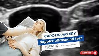 Carotid artery Doppler ultrasound test Accurate examination to perform a basic ultrasound carotid [upl. by Neerod]