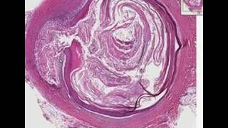 Histopathology SkinEpidermal inclusion cyst [upl. by Eldreda955]