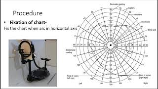 perimetry viva questions [upl. by Wengert]