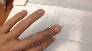 Broken finger pin removal [upl. by Niltac]