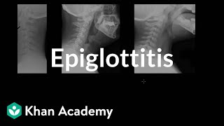 Epiglottitis diagnosis and treatment  Respiratory system diseases  NCLEXRN  Khan Academy [upl. by Nelleoj]