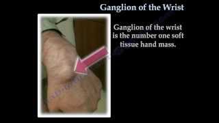 Ganglion Cyst Of The Wrist  Everything You Need To Know  Dr Nabil Ebraheim [upl. by Lunt]