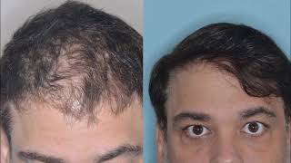 Unlocking Confidence Hair Restoration in Men  Anthony Bared MD FACS Miami FL [upl. by Boulanger]