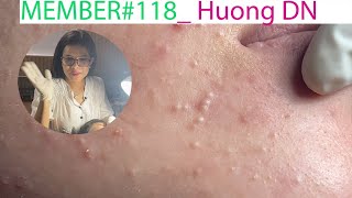 Acne Treatment Huong Da Nang 118 MEMBER [upl. by Minabe]