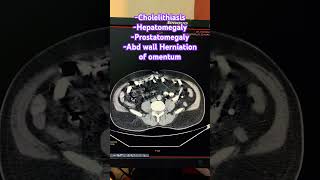 Cholelithiasis Hepatomegaly Prostatomegaly Abd wall Herniation of omentum trending ctscan [upl. by Moise]