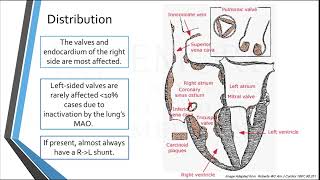 Carcinoid Heart Disease The known and yet to be known [upl. by Diskson146]