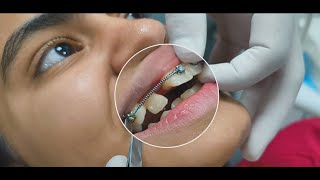 Correcting a BlockedOut Lateral Incisor Treatment Options and Solutions orthodontics [upl. by Nial]