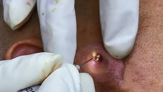 Big Cystic Acne Blackheads Extraction Blackheads amp Milia Whiteheads Removal Pimple Popping 063 [upl. by Larissa]