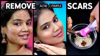 Acne Scars Home Remedies in Tamil  Pimple Marks Removal at Home [upl. by Masterson39]