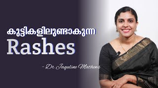 Rashes in babies  കുട്ടികളുടെ ദേഹത്തുണ്ടാകുന്നു തടിച്ച പാടുകൾ  remedy  Dr Jaquline Mathews BAMS [upl. by Haropizt]