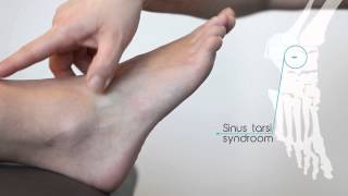 Sinus tarsi syndroom [upl. by Aimal]