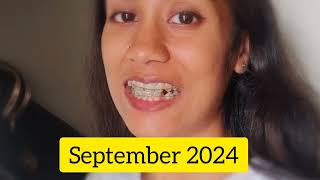 My braces timelapse Video  Varsha Daily Vlogs  bracesjourney [upl. by Yadrahs969]