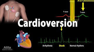 Cardioversion Electrical Procedure Animation [upl. by Esor]