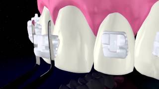 TruKlear Bracket product film [upl. by Assirok]