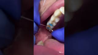 How We Fit Orthodontic Bands to make Orthodontic Expanders  Dr Bar The Braces Doc [upl. by Lindsley]