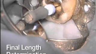 ProTaper® Universal Access amp Shaping Clinical Demo [upl. by Ayikan]