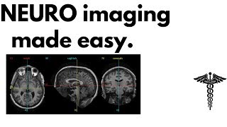 Neuroanatomy on MRI  Part 1 Cerebrum Basal Ganglia Thalamus Internal Capsule amp Lesions [upl. by Adlev]