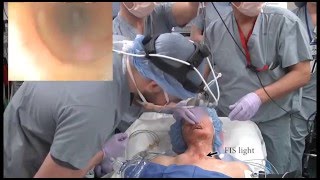 Inhalation Induction Apneic Intubation in a distorted airway from AOD [upl. by Llednar145]