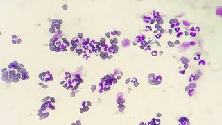 Neutrophilic Leukocytosis Blood smear examination [upl. by Lowenstein]