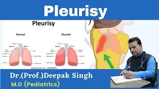 Pleurisy  pleuritis  Inflammation in plura  Deepak PD Singh [upl. by Amadus]