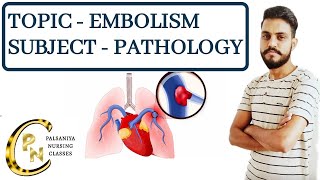 EmbolismDefinitiontypesPathogenesis Clinical manifestations Embolism in hindi by Palsaniya Sir [upl. by Rratsal]