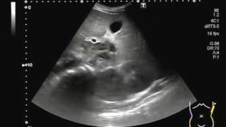 Ultrasound Video showing Hepatosplenomegaly with two small masses in porta hepatis [upl. by Maitund734]