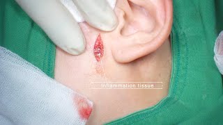 Old cyst inflammation mole like skin change excision surgery 피부가 점 처럼 변형된 오래된 낭종 제거 수술 [upl. by Lede]