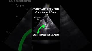 Coarctation Of Aorta corrected with Stent echocardiography for Beginners cardiology echo [upl. by Warwick]