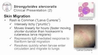 Helminths Strongyloides [upl. by Krishna]