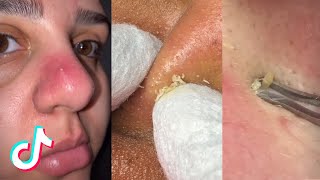 14 Minutes Of Pimple Popping TikTok Compilation [upl. by Himelman152]