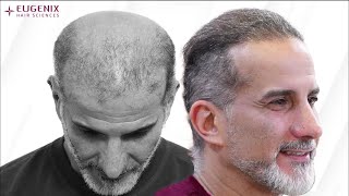 A lifechanging hair transplant at Eugenix uses 3566 grafts [upl. by Lisette832]