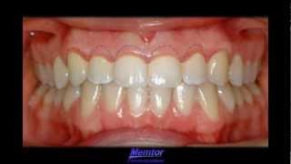 GingivoplastyGingivectomy [upl. by Lamonica]