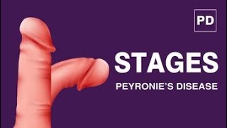 Stages of Peyronie’s Disease Peyronies Treatment for Curvature  Mansmatters Shockwave Therapy [upl. by Eceinert]