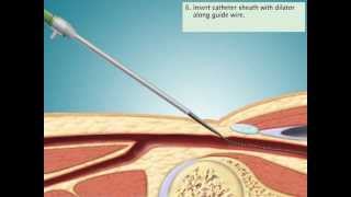 Cardiac Catheterization via Femoral Artery [upl. by Halil909]