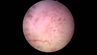 Endometrial Hyperplasia [upl. by Neerom]