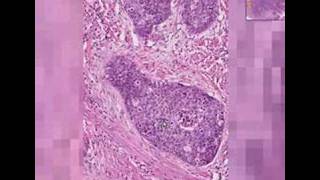 Histopathology Cervix Squamous cell carcinoma [upl. by Vento]