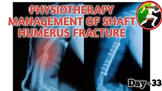 Day 33  Physiotherapy management of Fracture of Shaft of Humerus  shaft of Humerus fracture [upl. by Soraya523]