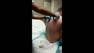 Large cyst Bursts out mans back Viewer beware [upl. by Naamann]