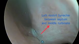 Synechiae release under local anesthesia [upl. by Aicil688]