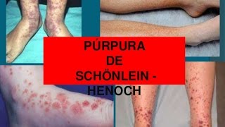 Purpura de Henoch schonlein  conferencia pediatria [upl. by Swagerty]