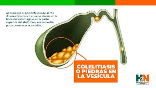 COLELITIASIS O PIEDRAS EN LA VESÍCULA [upl. by Burley]